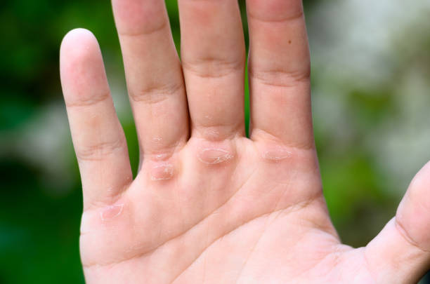 Close-up of a human hand showing blisters on palm, possibly from burns or friction, with a blurred green background.