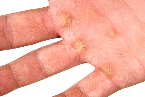 Quotes Makers | Overnight Methods to Soften Hand Calluses: Natural & Commercial Solutions