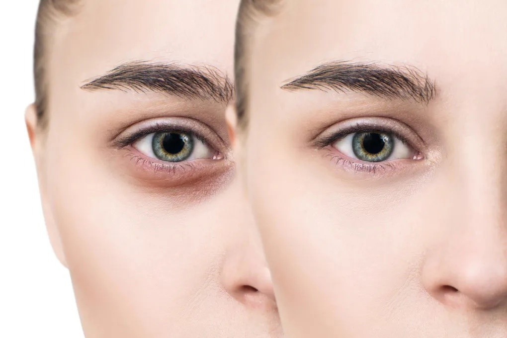 Steps to naturally reduce hollow under eyes