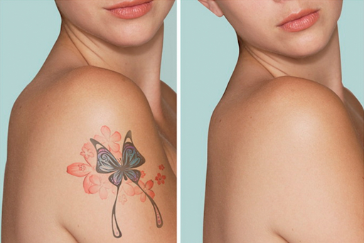 Saline tattoo removal process explained - everything you need to know