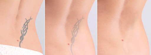 saline tattoo removal melbourne